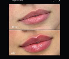 Lip Filler Russian, Lip Filler Inspo 1 Ml, Lip Filler 1 Ml, .5ml Lip Filler, Kim Kardashian 2000's, 0.5 Ml Lip Filler Before And After, 1.5 Ml Lip Filler