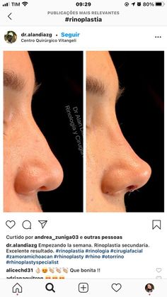 Nose Fillers, Lips Inspiration, Crazy Food, Straight Nose, Nose Makeup