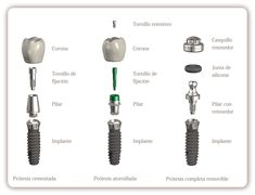 Tooth Implant, Dental Anatomy, Dental Implants Cost, Dental Technician, Dental Marketing, Teeth Implants, Dental Bridge