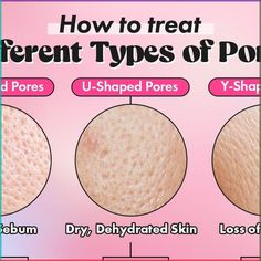 Pores On Face How To Get Rid Of At Home, How To Close Pores, Pore Minimizer Diy, Retinol Intense, Facial Massage Techniques, Haruharu Wonder, Big Pores, Nose Pores, Smaller Pores