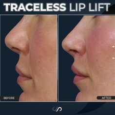 Lip Lift Before And After, Upper Lip Tie, Lip Lift Surgery, Lip Lift, Face Lift Surgery, Injectables Fillers, Small Lips, Lip Enhancement, Botox Injections