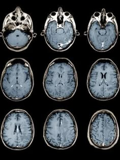 an mri scan shows the different areas of the brain