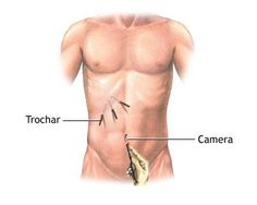 #LaparoscopicSurgery includes operations within the abdominal or pelvic cavities, whereas keyhole surgery performed on the thoracic or chest cavity is called Thoracoscopic surgery. Laparoscopic and Thoracoscopic surgery belong to the broader field of endoscopy. Gallbladder Stones, Bariatric Surgeon, Life Help, Bodybuilding Training, Do Your Best, Cavities, Bodybuilding