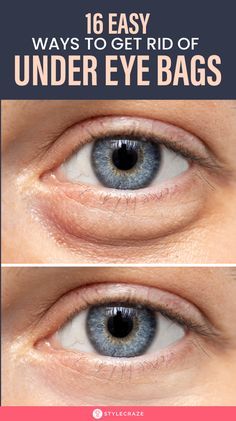 Eye Bag Remedies, Puffy Eyes Remedy, Baggy Eyes, Swollen Eyes, Under Eye Bags, Beauty Remedies, Tired Eyes, Looks Black