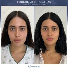 Jaw Reduction Surgery Before After, Round Face Surgery, Forehead Lowering Surgery, Face Contouring Surgery, Korean Plastic Surgeries, Rib Removal Surgery Before And After, Nose Surgery Before And After, Chin Reduction Surgery, Facial Contouring Surgery