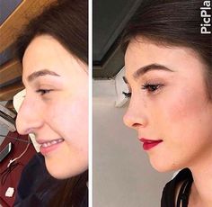 Possibly the best nose job I've ever seen Nose Plastic Surgery, Nose Reshaping, Plastic Surgery Gone Wrong, Rhinoplasty Surgery