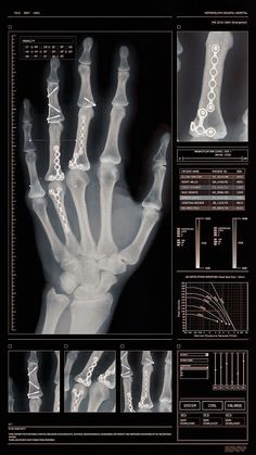 an x - ray image shows the bones and hand with different types of bone markings