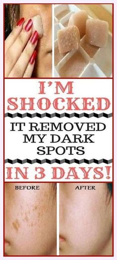 I’m SHOCKED It Removed My Dark Spots In 3 Days, Magic Remedy Spots On Skin, Brown Spots Removal, Brown Spots On Face, Dark Under Eye, Fade Dark Spots, Brown Spots, Diy Skin