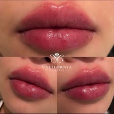 Lips Shape, Face Fillers, Botox Lips, Cheek Fillers, Facial Fillers, Facial Aesthetics, Lip Contouring, Lip Shapes