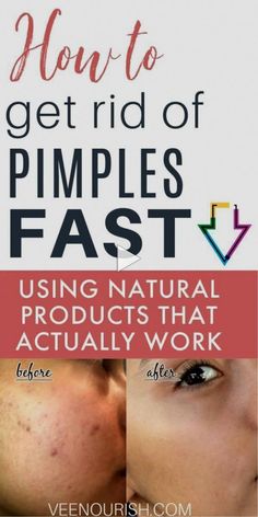 Clear Up Acne Fast, Clear Up Acne, Acne Routine, Acne Tips, Get Rid Of Pimples, Rid Of Pimples, Skin Bumps, Get Rid Of Warts, Acne Skincare Routine