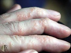 pom-fing Rash On Hands, Skin Blisters, Skin Disorders, Medical Knowledge, Skin Diseases, Health Info, Health And Beauty Tips, Skin Conditions, Health Remedies