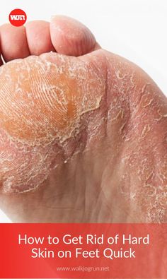 The Best Natural Remedies for Dry Skin Peeling Skin On Feet How To Get Rid Of, Heel Callus Remover Diy, How To Get Rid Of Dry Skin On Feet Heels, How To Get Dry Skin Off Feet, Peeling Feet Remedy Diy, Dry Feet How To Get Rid Of, Dry Calloused Feet Remedy, How To Get Rid Of Dry Feet Skin, Feet Cracks Remedies