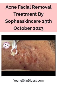 Get ready for a skincare treat! This amazing video by Sopheaskincare is all about removing acne through a fabulous facial treatment. You know… Acne Recipes, Redness Pimple, Acne Vulgaris, Acne Removal, Home Remedies For Acne, Natural Acne, Diy Facial, Acne Facial