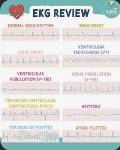 Ekg Nursing, Sinus Rhythm, King Abdulaziz, Nursing Instructor, Normal Sinus Rhythm, Nclex Study, Nursing School Motivation