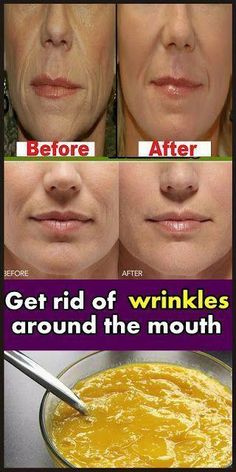 Mouth Wrinkles, Get Rid Of Wrinkles, Skin Care Routine For 20s, Wrinkled Skin, Unwanted Hair Removal, Deep Wrinkles