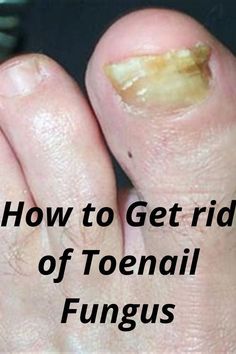 VDiy nail fungus treatment toenails | nail fungus remedy | nail fungus cure

My sister tryed many doctors and many creams and gel but she remove nail fungus only because of 1 at home ingredients | Toenail Fungal Infection, Toenail Fungus Remedies, Nail Infection, Fungal Nail, Toenail Fungus, Fungal Infection, Nail Fungus, Healthy Nails, Natural Home Remedies