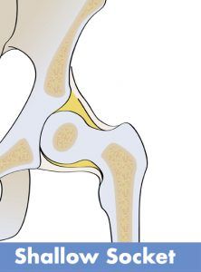 Developmental Dysplasia Of The Hip, Hip Dislocation, Inner Thigh Muscle, Synovial Fluid, Psoas Muscle, Body Joints, Thigh Muscles