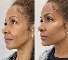 Jaw Reduction Surgery, Facial Procedure, Non Surgical Facelift