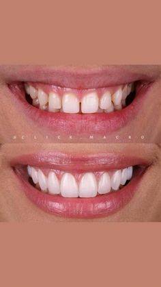 #WhatIsOralCareSystem Whiten Teeth At Home, Teeth Whitening At Home, How To Remove Warts, Remove Warts, Dental Cavities, Porcelain Veneers, Whiten Teeth, Yellow Teeth