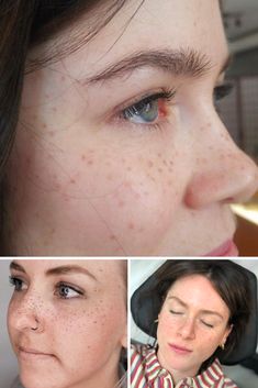 three different pictures of a woman with freckles on her face and the other side of her face