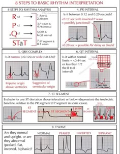 How To Read Ekg, Ekg Interpretation Made Easy, Nursing Cardiovascular, Paramedic Study, Nursing Med Surg, Ekg Tech, Ekg Rhythms, Pathophysiology Nursing