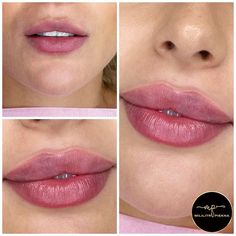 Best Lip Shape, Face Plastic Surgery, Wax Roller