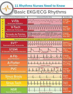 Room Basic, Paramedic School, Nursing Student Tips, Medical Student Study, Cardiac Nursing, Critical Care Nursing