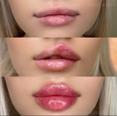 Doll Lips Filler, 1 Ml Lip Filler, Lip Fillers Before And After 1ml, Lip Plastic Surgery, Plastic Surgery Fails, 1ml Lip Filler, Dermal Fillers Lips, Extreme Plastic Surgery, Juvederm Lips