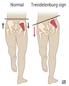 Here are 4 unique gluteus medius exercises to strengthen your hips and help with knee pain, knock knees, bad balance, and more. Gluteus Medius Exercises, Hip Strengthening Exercises, Glute Medius, Knock Knees, Lower Back Pain Exercises, Gluteus Medius, Posture Exercises, Knee Exercises, Mobility Exercises