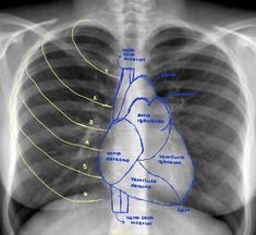 an x - ray shows the location of the heart in the chest