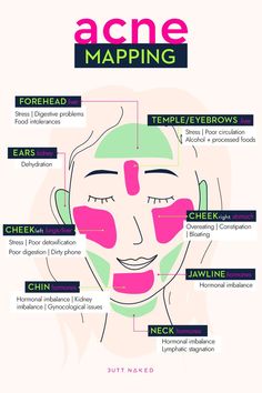 Acne Map, How To Treat Pimples, Different Types Of Acne, Face Mapping Acne, Forehead Acne, Skin Diet, Acne Help, Face Mapping, Acne Treatments