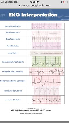 Heart Rythym Chart, Cardiology Terminology, Ekg Technician Aesthetic, Cardiac Nursing Cheat Sheets, Cardiovascular Technologist, Cardiology Study, Paramedic Student