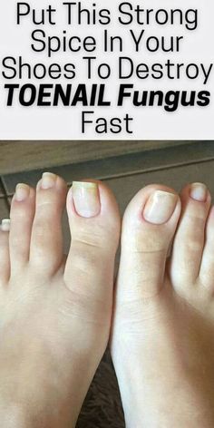 Scientists at the Infectious Disease Society of America have discovered that tea tree oil can actually worsen foot fungus… #Fungal_Infection_Remedies #Toenail_Health #Toenail_Fungal_Infection #Infected_Toenail | Fungal Infection Remedies, Toenail Health, Toenail Fungal Infection, Nail Remedies, Toenail Fungus Remedies, Nail Problems, Nail Infection, Fungal Nail, Clear Nail Fungal Infection Remedies, Toenail Health, Toenail Fungal Infection, Toenail Fungus Remedies, Nail Problems, Clear Nail