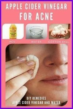 Acv For Acne, Apple Cider Vinegar For Acne, Remedy For Acne, Apple Cider Vinegar Acne, Apple Cider Vinegar Remedies, Kat Diy, Diy Acne, Natural Acne Remedies, Natural Acne