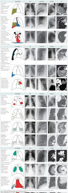 an image of the chest with different types of lungs and their corresponding areas in each section