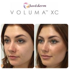 Voluma Cheeks, Juvederm Lips, Derma Fillers, Cheek Fillers, Facial Fillers, Character Change, Cosmetic Clinic, Facial Aesthetics, Lip Enhancement