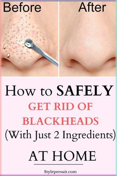 You can easily get rid of these blackheads by using natural or home remedies for blackhead treatment. Click to read How to get rid of blackheads diy| The best blackheads removal on nose| get rid of blackhads on face| get rid of blackheads on nose| how to get rid of blackheads naturally ... Natural Blackhead Remover, Remedies For Blackheads, Reverse Wrinkles, Remove Blackheads From Nose, How To Remove Blackheads, Facial Massage Techniques, Overnight Skin Care, Blackhead Remover Diy