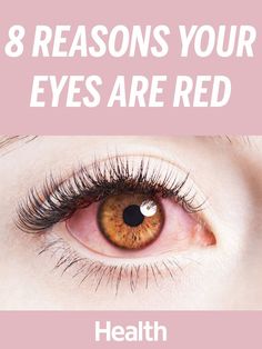 Red Veins In Eyes, What Causes Red Eyes, Frankincense Oil Uses, Bloodshot Eyes, Calendula Benefits, Coconut Health Benefits, Red Patch, Benefits Of Coconut Oil