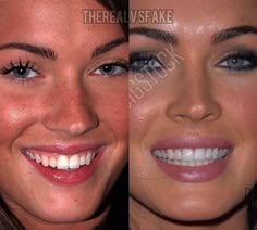 Celebrity Teeth Before And After, Celebrity Teeth Women, Megan Fox Before After, Hollywood Smile Teeth, Before After Surgery