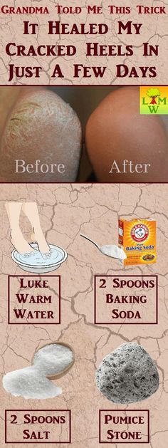 Cracked Feet Remedies, Cracked Heel Remedies, Heal Cracked Heels, Baking Soda Shampoo, Cracked Heels, Health Remedies