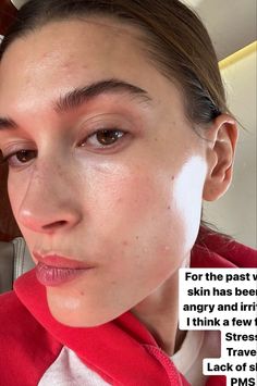 Hailey Bieber No Makeup, Hailey Bieber Without Makeup, Hailey Bieber Eyebrows, Hailey Bieber Nose, Hailey Bieber Skin, Celebrities With Acne, Real Skin, Hailey Bieber Nose Job, Hailey Bieber Freckles