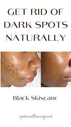 Black Skin Care Dark Spots, Bad Acne, Dark Spots On Face, Black Skin Care, Spots On Face, Remove Dark Spots, Skin Care Recipes, Face Skin Care, Face Skin