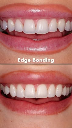 Chipped Tooth Repair, Teeth After Braces, Teeth Bonding, Teeth Veneers, Composite Bonding, Teeth Aesthetic, Chipped Tooth