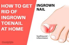 Here are some very simple and effective home remedies that will reduce your long-lasting discomfort.Let us read to know how to get rid of an ingrown toenail | Broken Toenail, Infected Toenail, Nail Remedies, Nail Infection, Ingrown Toenail, Ingrown Nail, Ingrown Toe Nail, Toenail Fungus, Nail Fungus Broken Toenail, Infected Toenail, Nail Remedies, Nail Infection, Ingrown Toenail, Ingrown Nail, Fungal Nail, Ingrown Toe Nail, Toenail Fungus