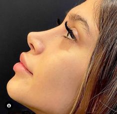 Ethnic Rhinoplasty, Nose Fillers, Rhinoplasty Nose Jobs, Face Surgery, Job Inspiration, Pretty Nose, Perfect Nose, Facial Fillers, Small Nose