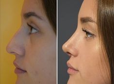 Nose Reshaping, Plastic Surgery Gone Wrong, Face Surgery