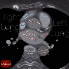 an x - ray shows the location of the left atrium and right ventrical