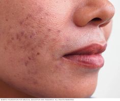 Acne - Symptoms and causes - Mayo Clinic Post Inflammatory Hyperpigmentation, Acne Free Skin, Sweat Gland, Skin Care Steps, Acne Free, Acne Marks, Prevent Acne, Skin Issues