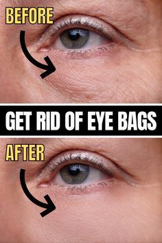 Undereye Bags Remedy, Get Rid Of Eye Bags, Rid Of Eye Bags, Saggy Neck, Natural Skin Care Remedies