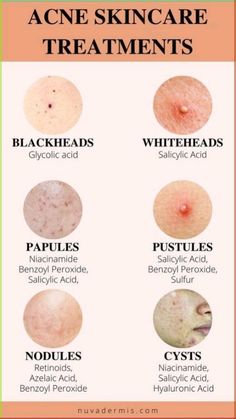 Haut Routine, Face Care Tips, Natural Skin Care Remedies, Natural Acne, Good Skin Tips, How To Get Rid Of Pimples, Acne Solutions, Acne Remedies